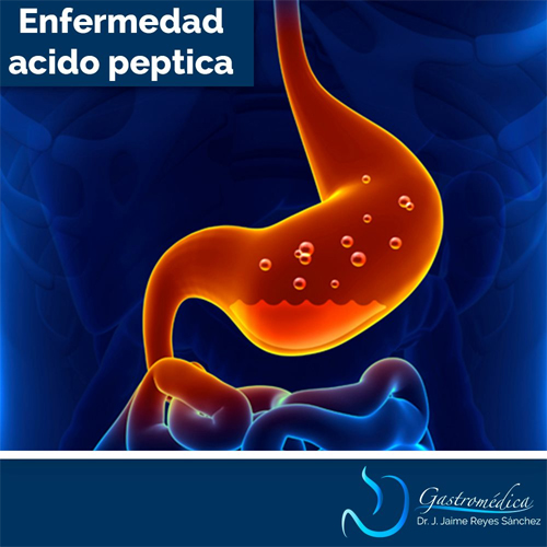 Enfermedad Ácido Peptica