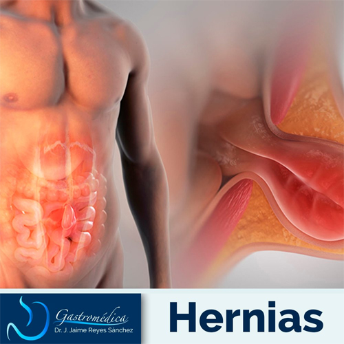 Cirugia de Hernias