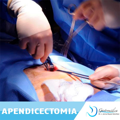 Apendicectomía