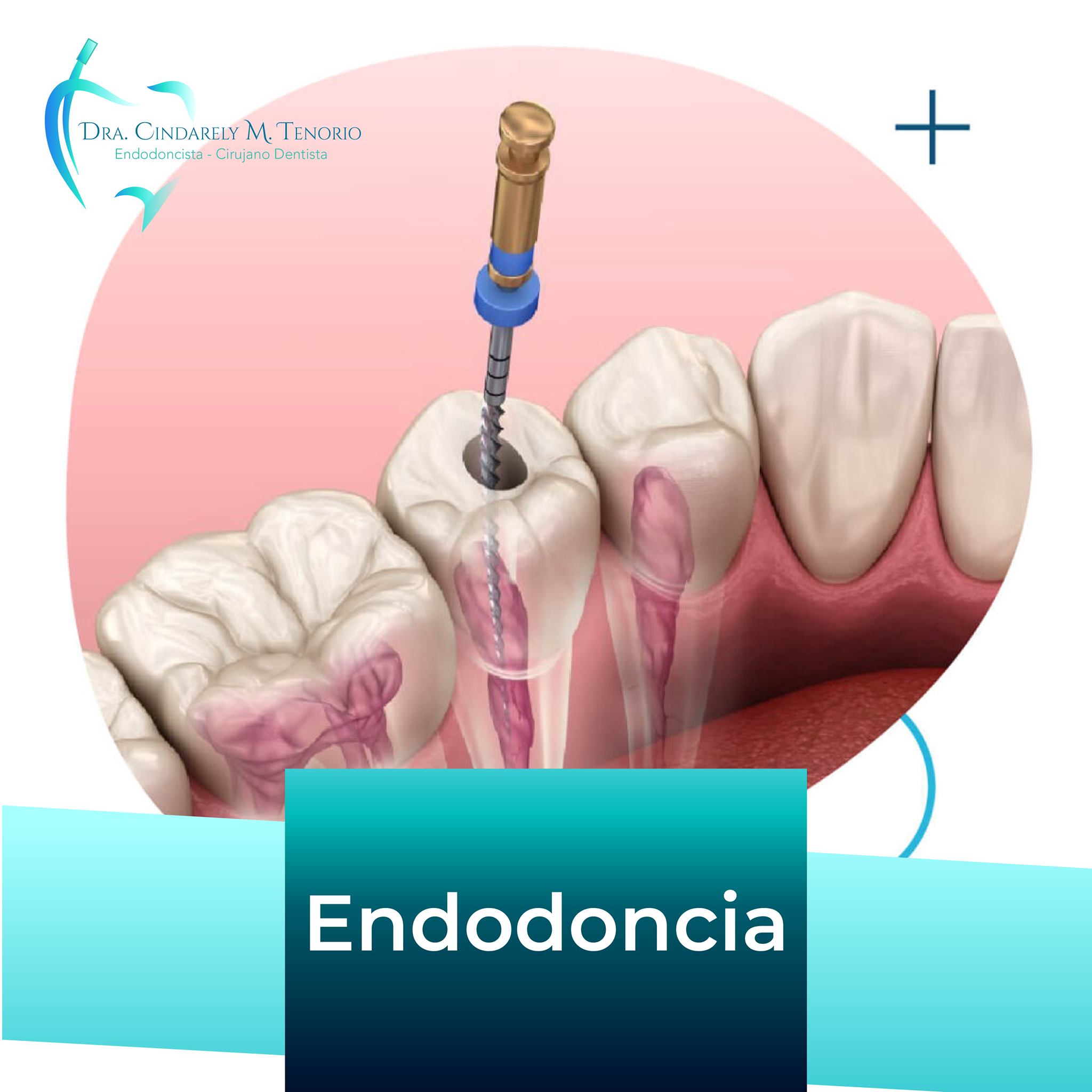  Endodoncia