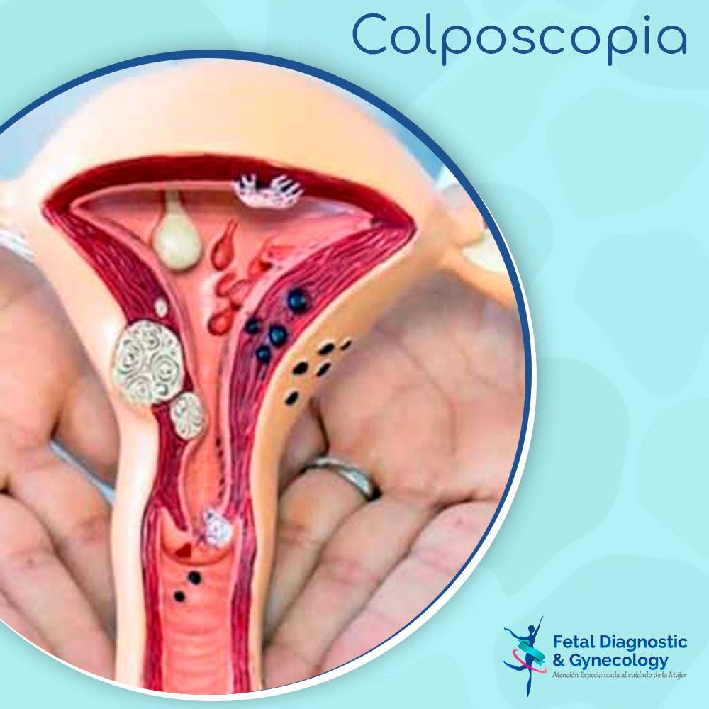 Colposcopía 